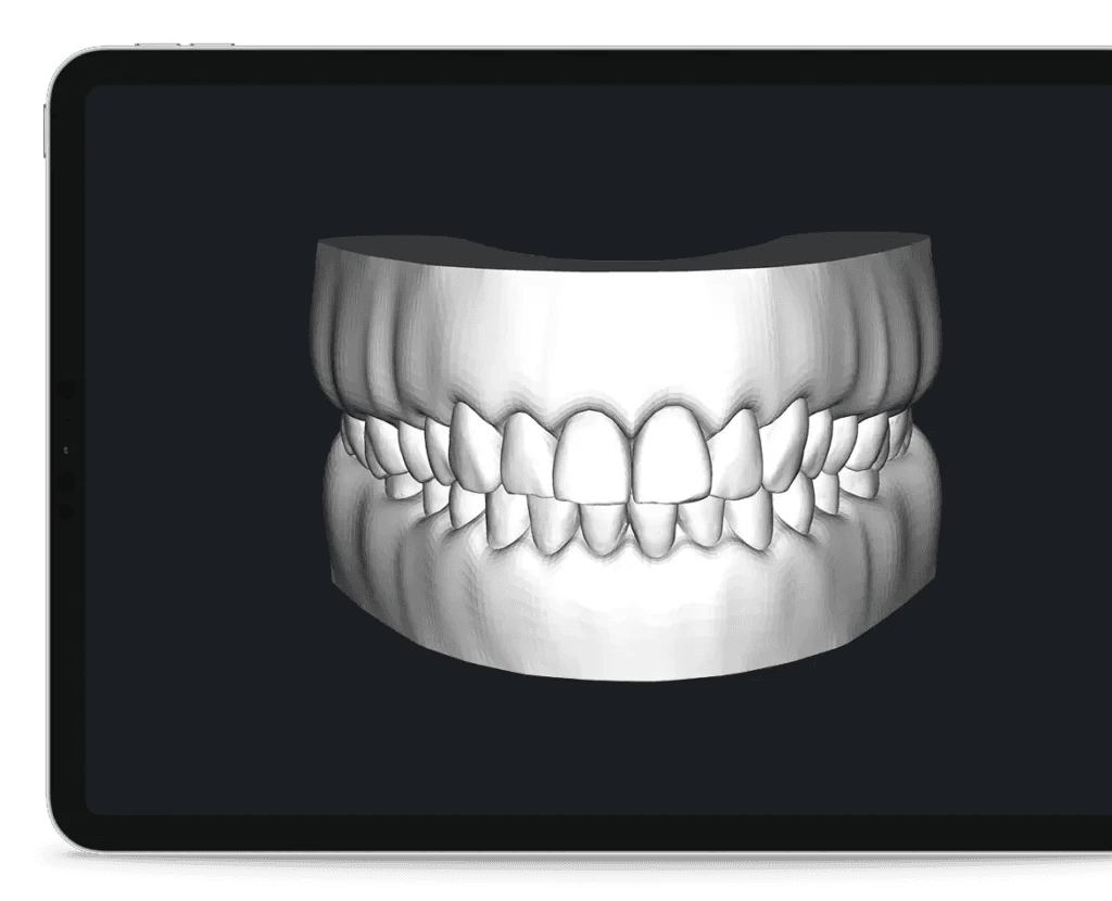 Upper and lower dental arch models.